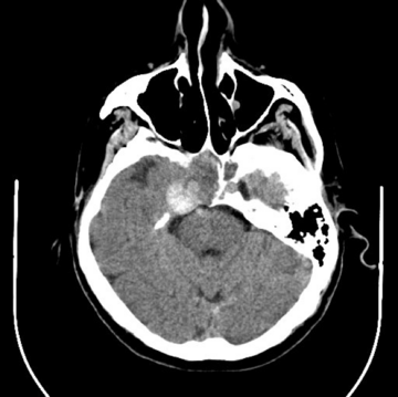 Axial CT