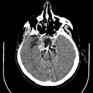 Axial CT