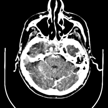 Axial CT with contrast