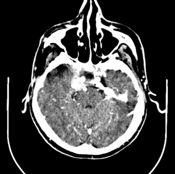 Axial CT with contrast