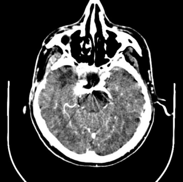 Axial CT with contrast