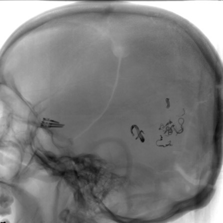 11-the-order-of-the-factors-does-alter-the-result-dsa-post-surgical-avm-resection-2