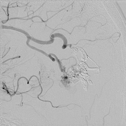 7-the-order-of-the-factors-does-alter-the-result-avm-embolization