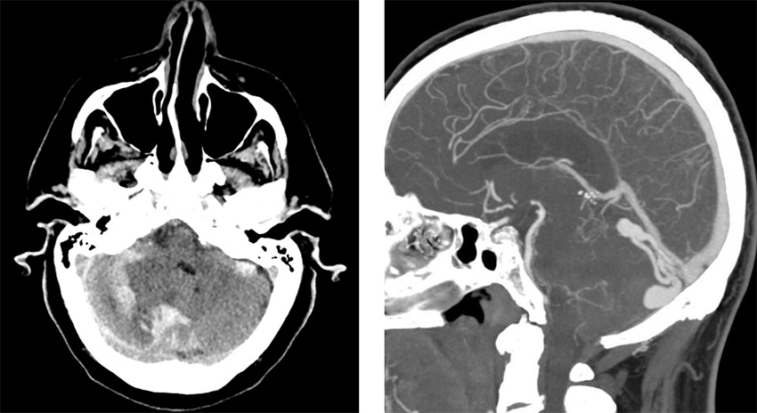 Transarterial-Embolization-of-Straight-Sinus-Dural-Arteriovenous-Fistula