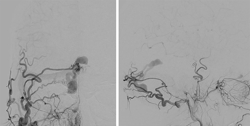 Transarterial-Embolization-of-Straight-Sinus-Dural-Arteriovenous-Fistula