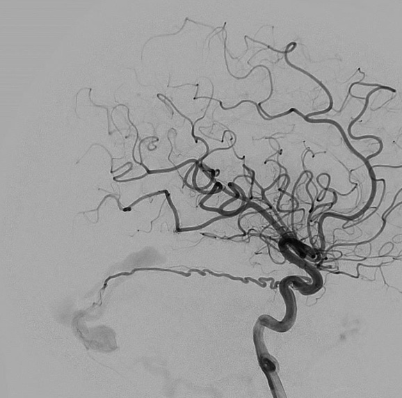 Transarterial-Embolization-of-Straight-Sinus-Dural-Arteriovenous-Fistula