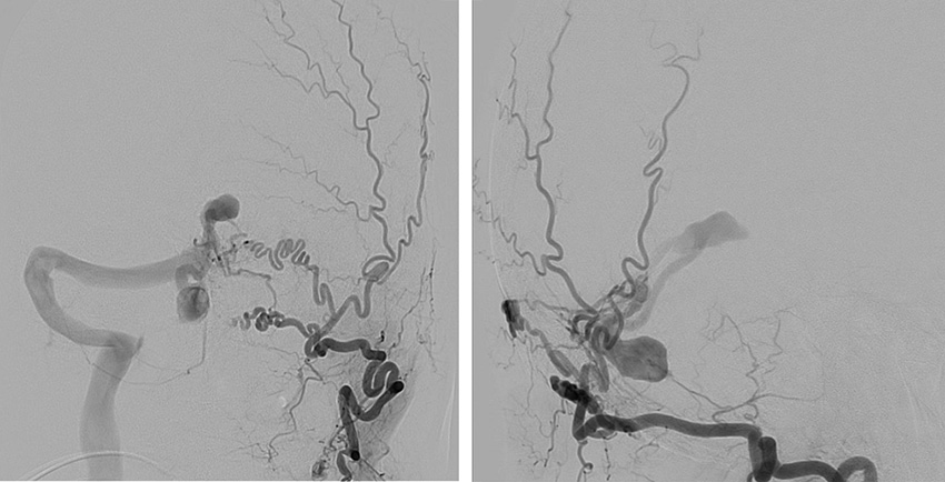 Transarterial-Embolization-of-Straight-Sinus-Dural-Arteriovenous-Fistula