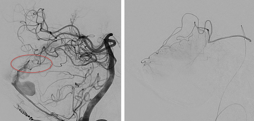 Transarterial-Embolization-of-Straight-Sinus-Dural-Arteriovenous-Fistula