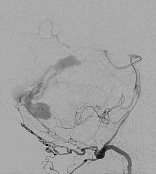 Transarterial-Embolization-of-Straight-Sinus-Dural-Arteriovenous-Fistula