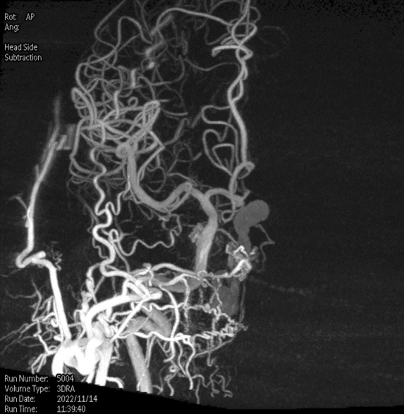 Transarterial-Embolization-of-Straight-Sinus-Dural-Arteriovenous-Fistula