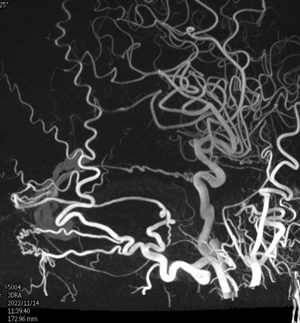 Transarterial-Embolization-of-Straight-Sinus-Dural-Arteriovenous-Fistula