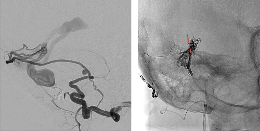 Transarterial-Embolization-of-Straight-Sinus-Dural-Arteriovenous-Fistula