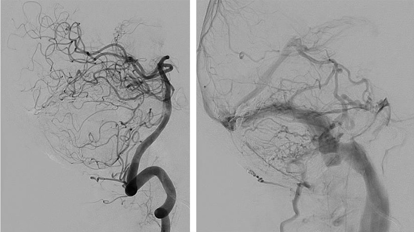 Transarterial-Embolization-of-Straight-Sinus-Dural-Arteriovenous-Fistula