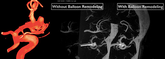 balloon assisted WEBing