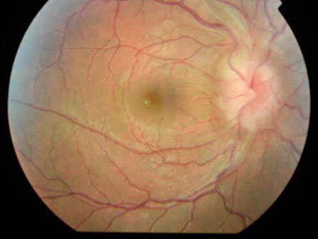 image1-venous-sinus-stenting-in-idiopathic-intracranial-hypertension-fundoscopy-revealed-bilateral-papilledema-1