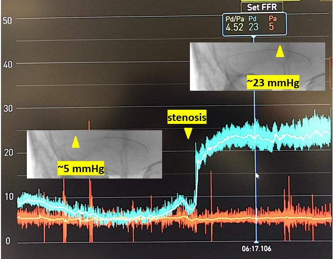 image10-venous-sinus-stenting-in-idiopathic-intracranial-hypertension-pressure-measurement-2
