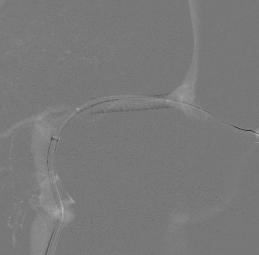 image12-venous-sinus-stenting-in-idiopathic-intracranial-hypertension-procedure-right-ica-select-5f-catgheter-2