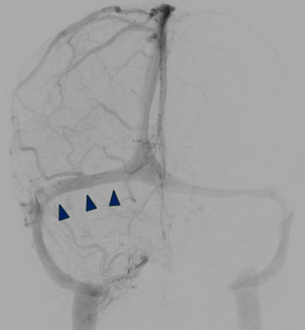 image13-venous-sinus-stenting-in-idiopathic-intracranial-hypertension-procedure-right-ica-select-5f-catgheter-3