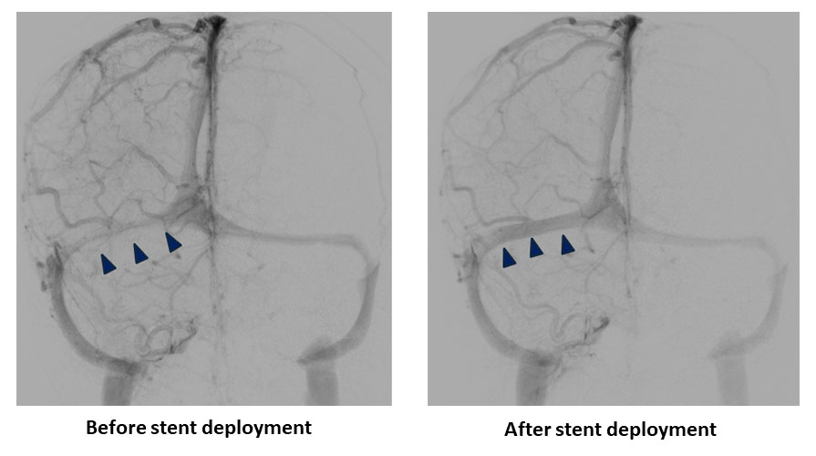 image14-venous-sinus-stenting-in-idiopathic-intracranial-hypertension-procedure-before-after-stent-deployement-1