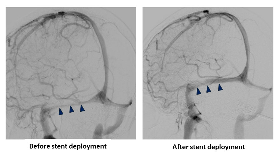 image15-venous-sinus-stenting-in-idiopathic-intracranial-hypertension-procedure-before-after-stent-deployement-2