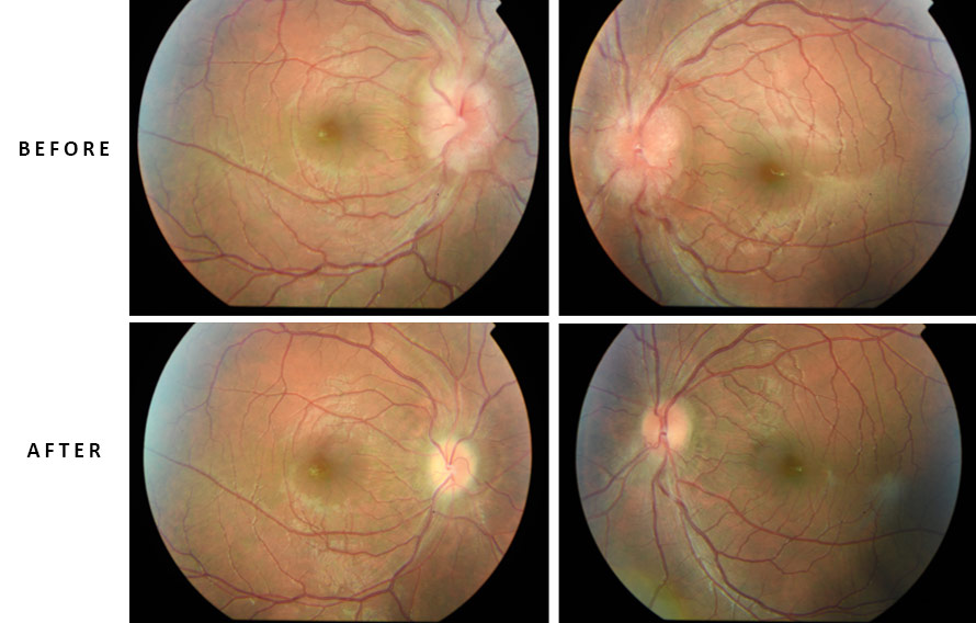 image16-venous-sinus-stenting-in-idiopathic-intracranial-hypertension-after-procedure-1