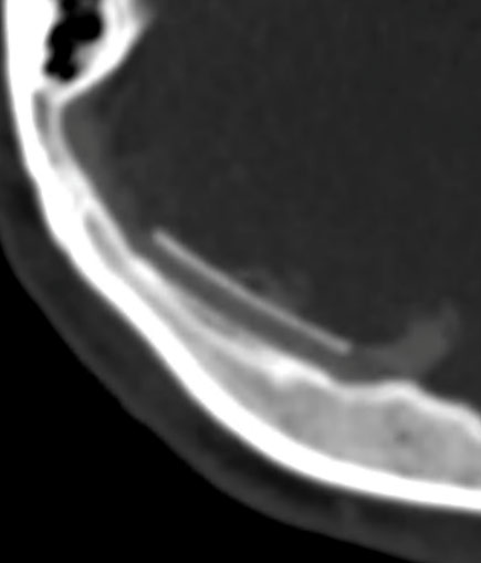 image18-venous-sinus-stenting-in-idiopathic-intracranial-hypertension-follow-up-1