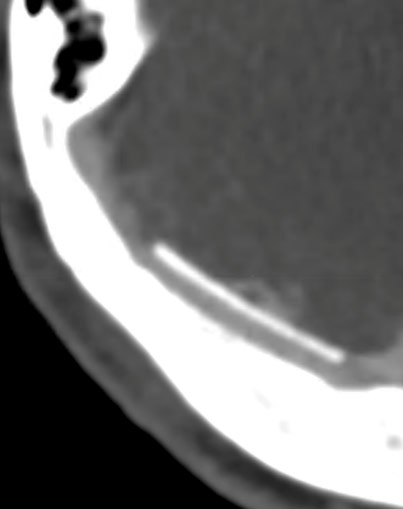 image19-venous-sinus-stenting-in-idiopathic-intracranial-hypertension-follow-up-2