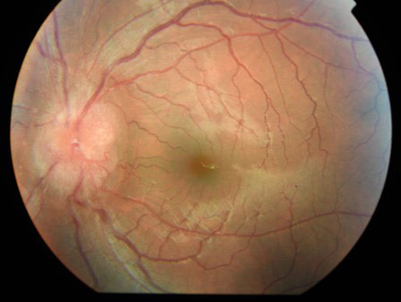 image2-venous-sinus-stenting-in-idiopathic-intracranial-hypertension-fundoscopy-revealed-bilateral-papilledema-2
