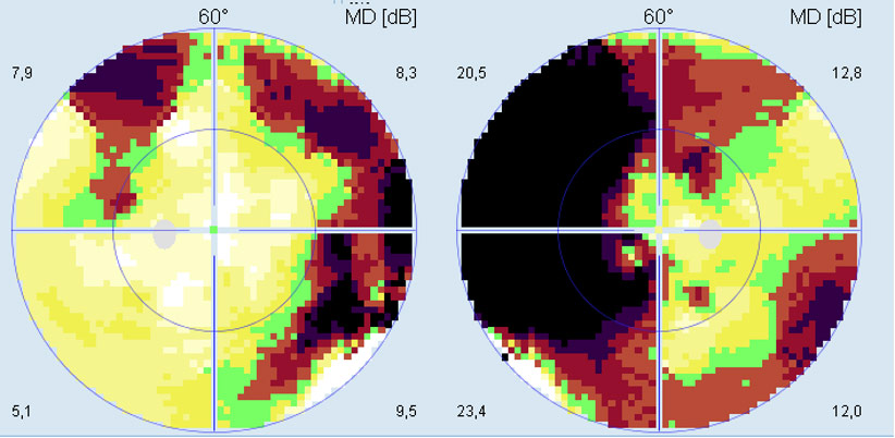 image3-venous-sinus-stenting-in-idiopathic-intracranial-hypertension-campimetry-revealed-bilateral-peripheral-depression