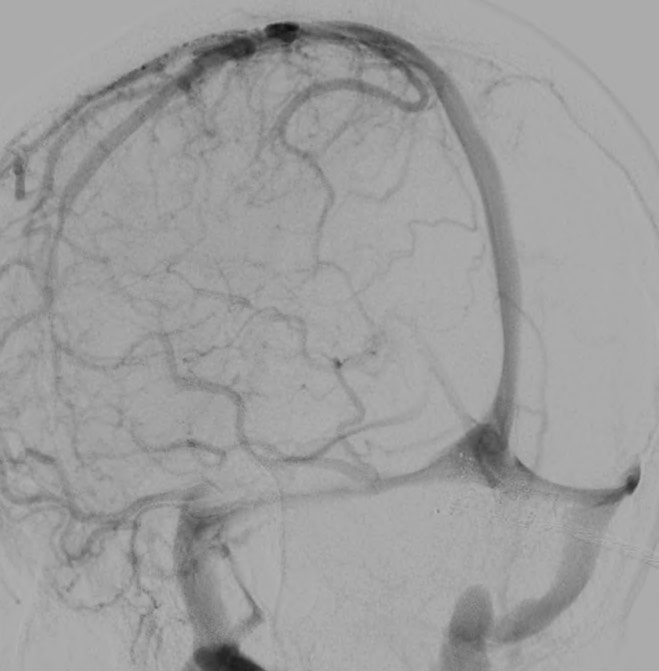 image6-venous-sinus-stenting-in-idiopathic-intracranial-hypertension-dsa-right-transverse-sinus-stenosis-2