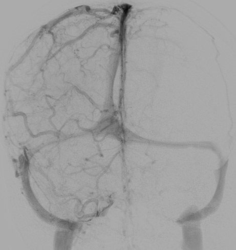 image7-venous-sinus-stenting-in-idiopathic-intracranial-hypertension-dsa-right-transverse-sinus-stenosis-3