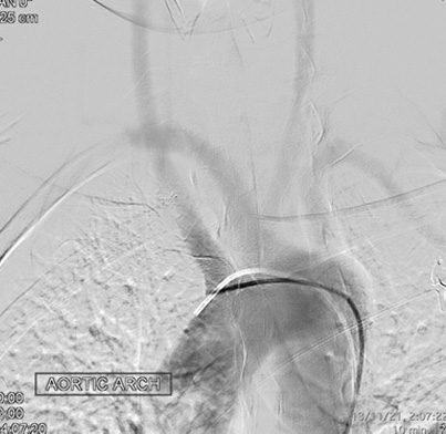 prolapsing flow diverter stent in a giant aneurysm