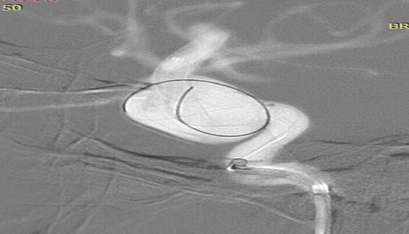 prolapsing flow diverter stent in a giant aneurysm