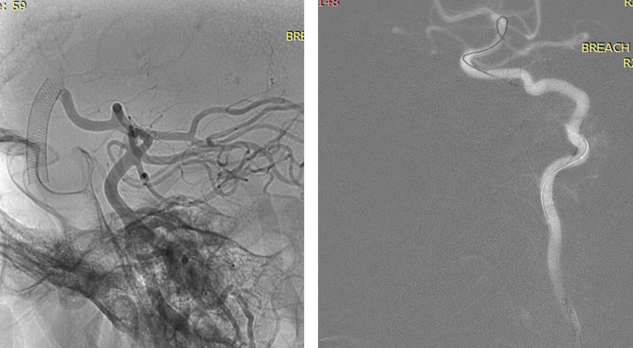 prolapsing flow diverter stent in a giant aneurysm