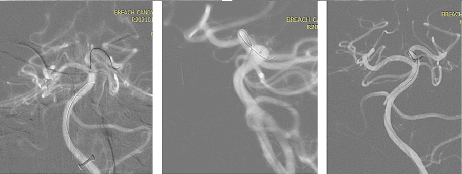 prolapsing flow diverter stent in a giant aneurysm