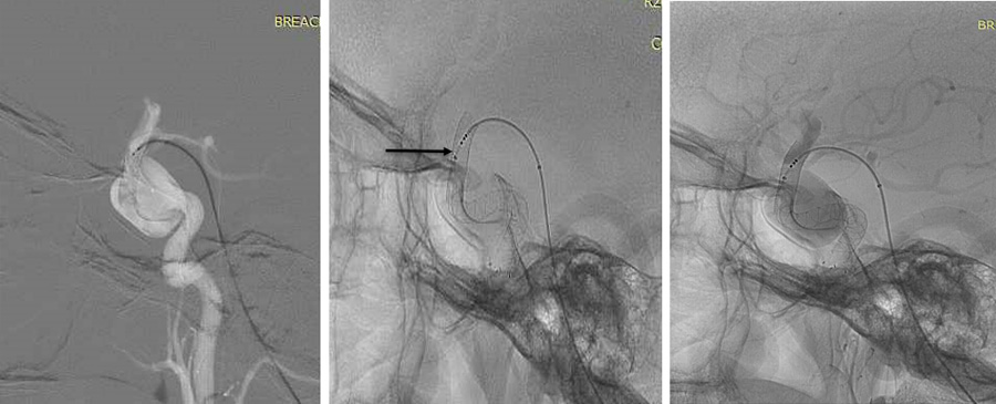 prolapsing flow diverter stent in a giant aneurysm