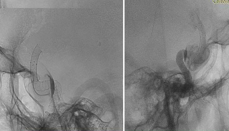 prolapsing flow diverter stent in a giant aneurysm