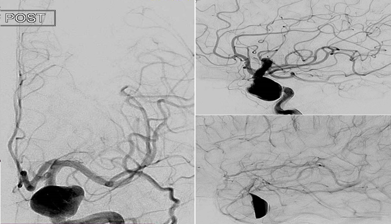 prolapsing flow diverter stent in a giant aneurysm