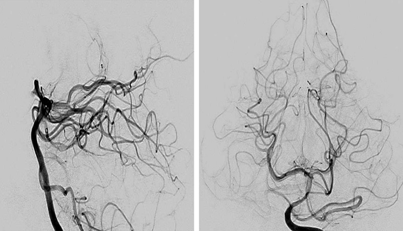 prolapsing flow diverter stent in a giant aneurysm