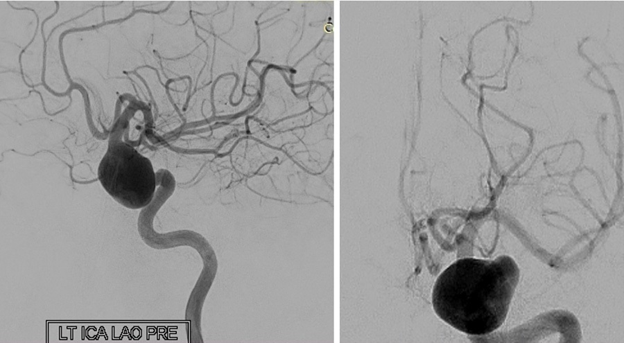 prolapsing flow diverter stent in a giant aneurysm