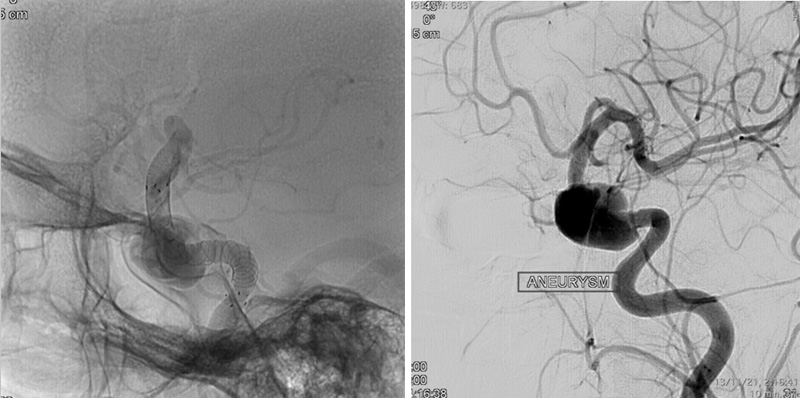 prolapsing flow diverter stent in a giant aneurysm