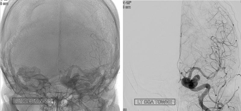 prolapsing flow diverter stent in a giant aneurysm