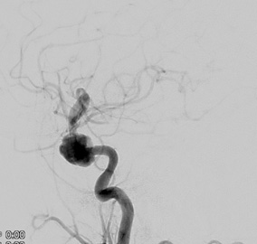 prolapsing flow diverter stent in a giant aneurysm