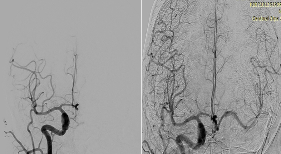 prolapsing flow diverter stent in a giant aneurysm