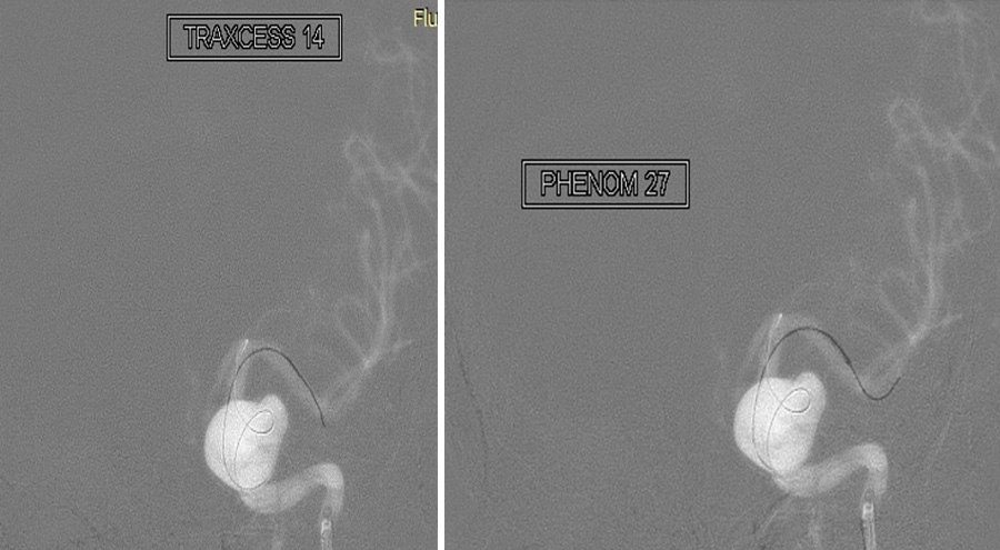 prolapsing flow diverter stent in a giant aneurysm