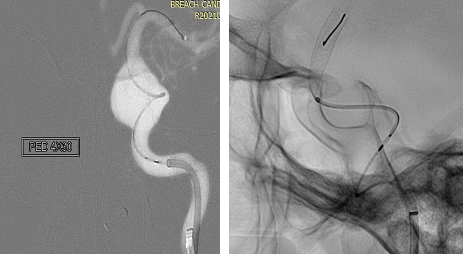 prolapsing flow diverter stent in a giant aneurysm