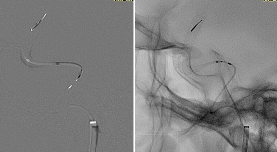 prolapsing flow diverter stent in a giant aneurysm