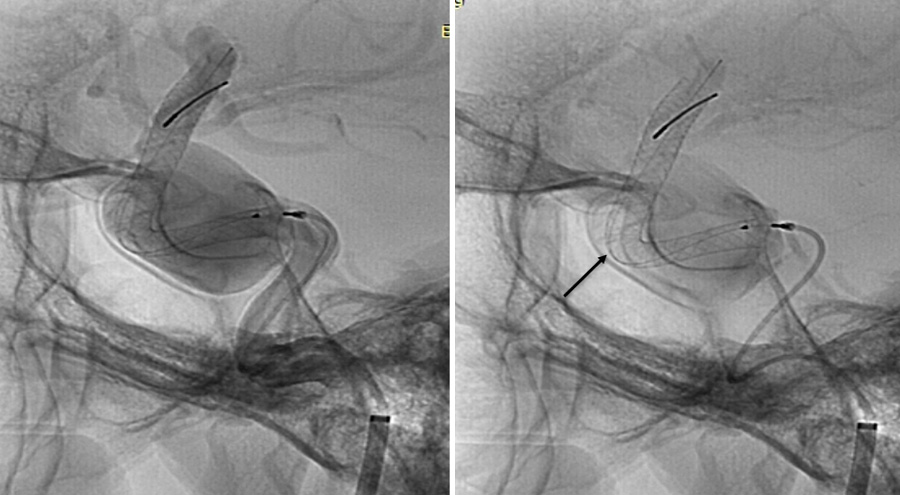 prolapsing flow diverter stent in a giant aneurysm