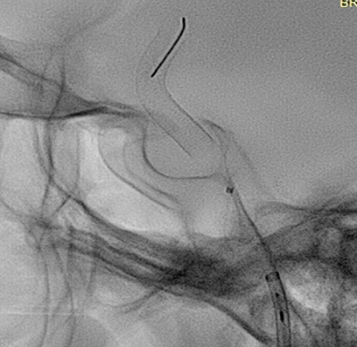 prolapsing flow diverter stent in a giant aneurysm