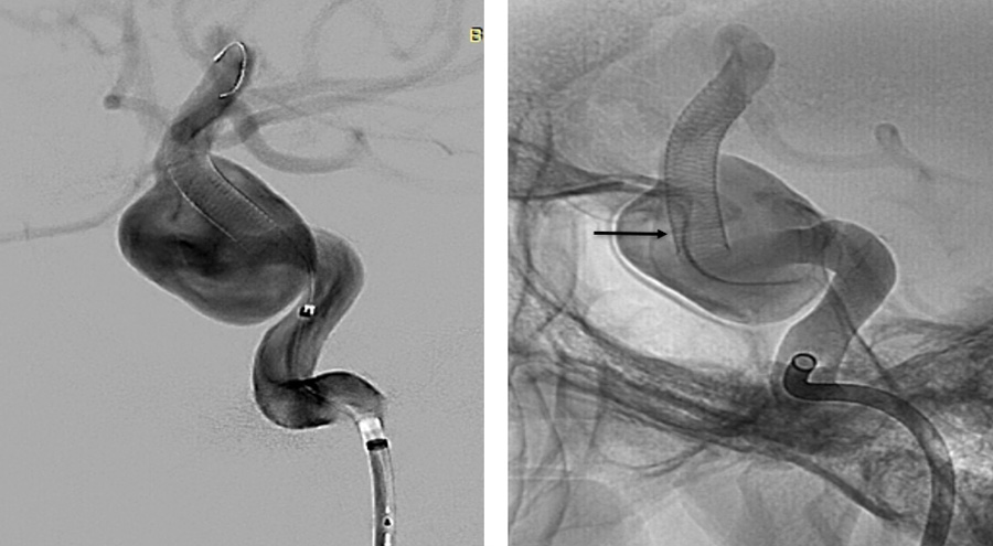 prolapsing flow diverter stent in a giant aneurysm